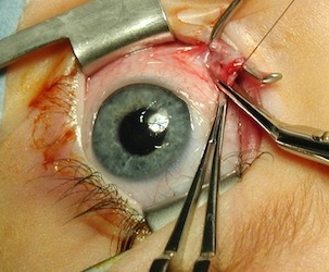 Eye Surgery